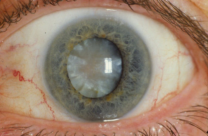 What Is A Cataract?