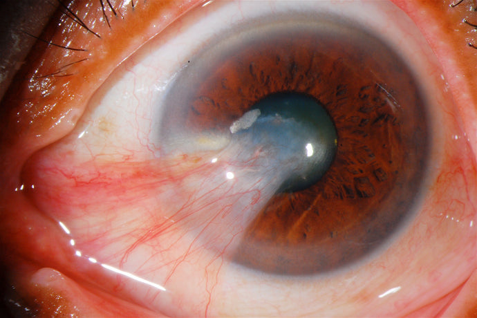What is Pterygium of the Eye?